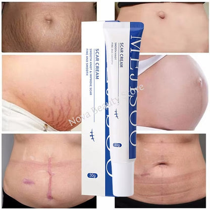 Scar Removal Cream™ — Crema para mejorar la apariencia de cicatrices